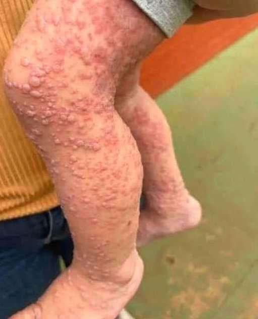 His whole body was itchy, he thought it was an allergy and was diagnosed...See more
