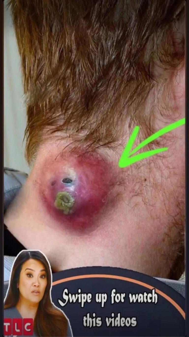 Their acne is severe