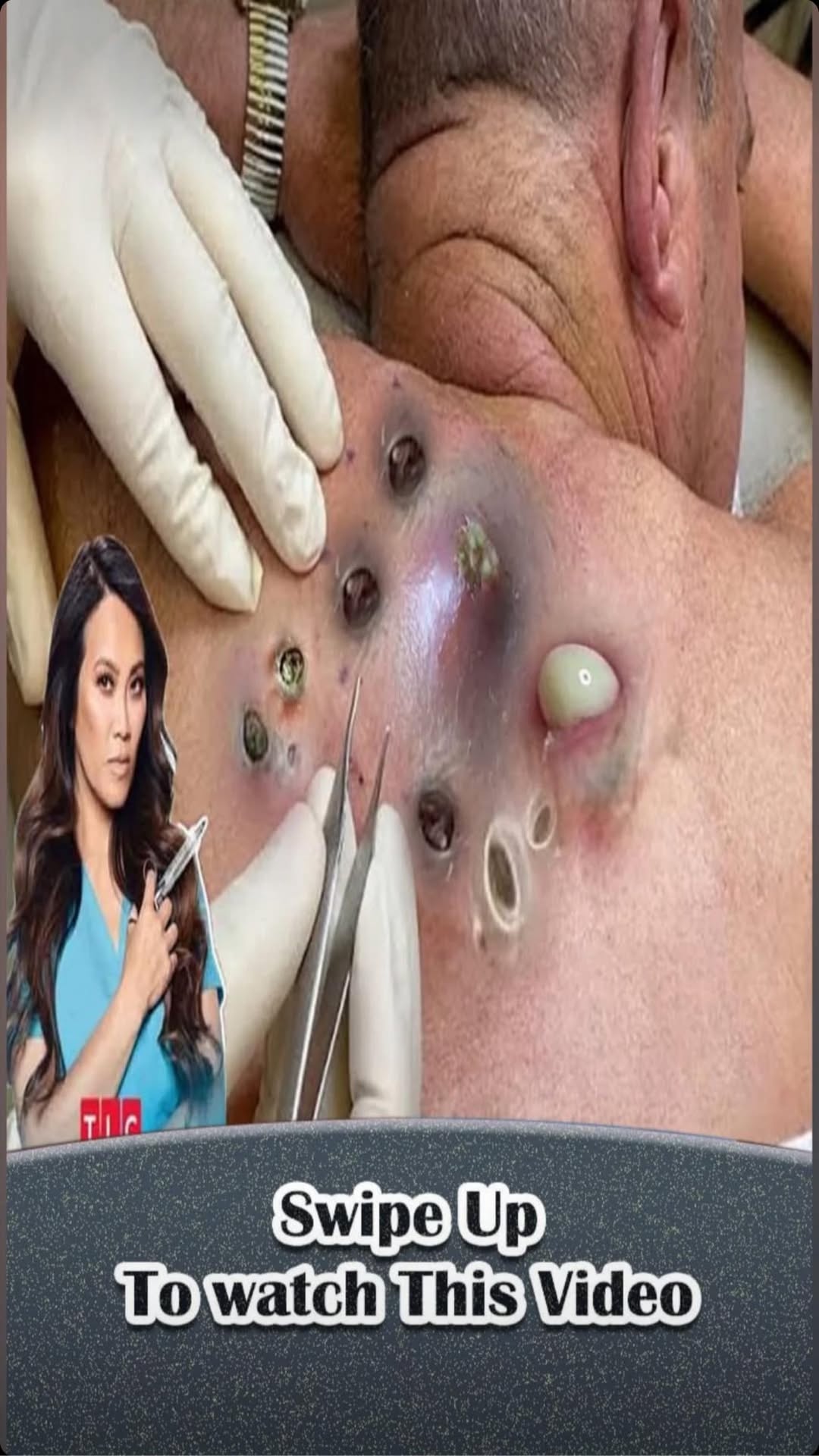 Why Acne Appears on These 8 Body Areas, and What You Should Do