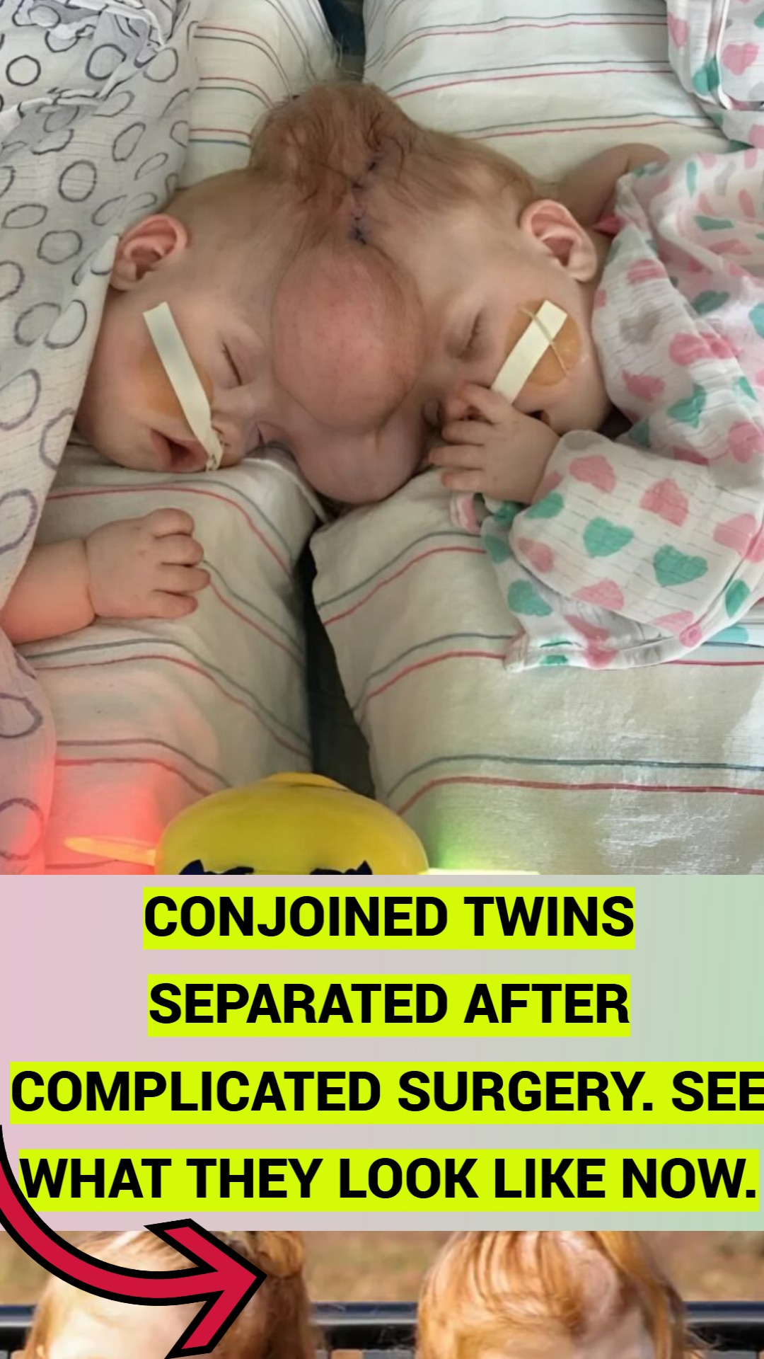 Conjoined twins separated after complicated surgery. See what they look like now.