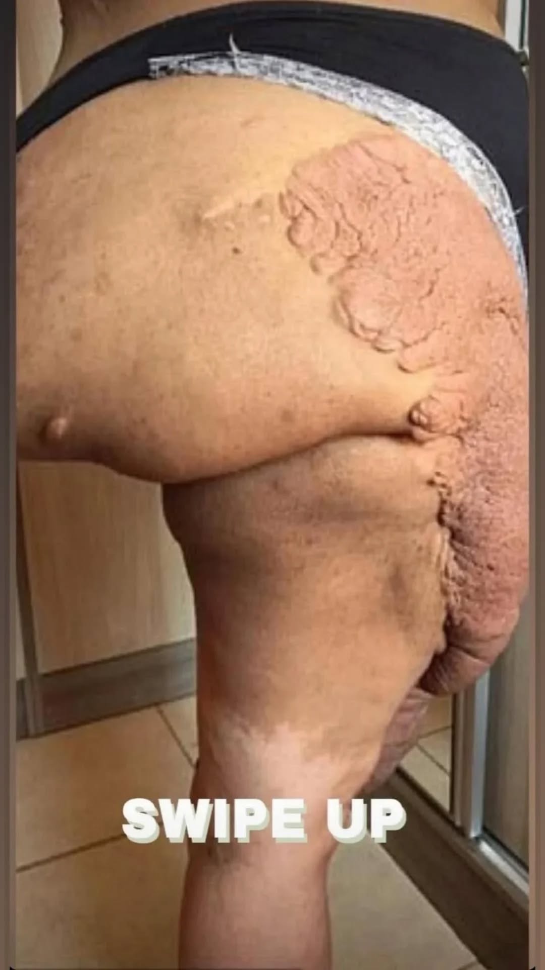 Neurofibroma Understanding Its Origins, Signs, and Treatment Options