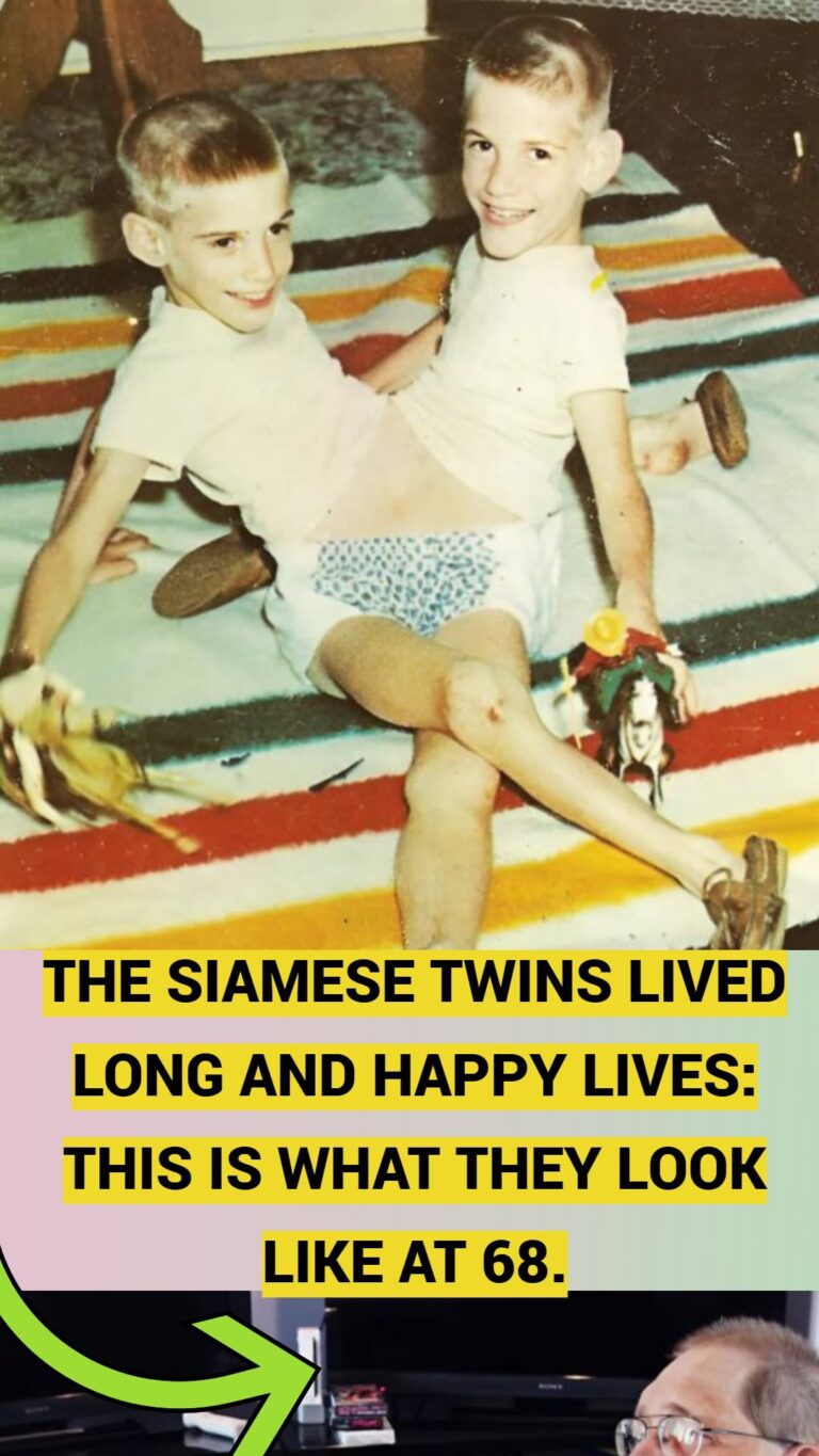 Siamese Twins Lived Long and Happy Lives-Here’s What They Look Like at Age 68