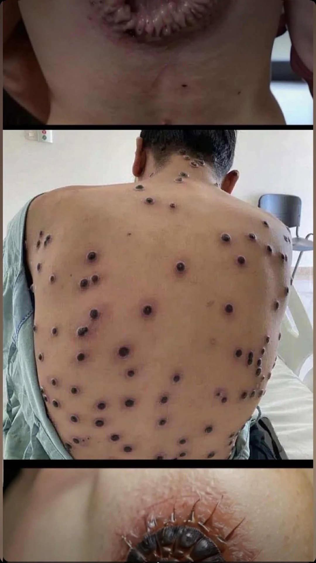 📌 Back Acne (Bacne) What It Means and Why It Happens